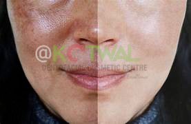 Melasma